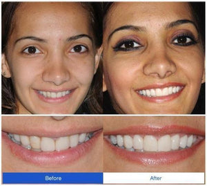 Snap On Veneers